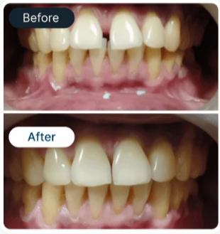 Patient smile makeover 2 - SmileBetter Kochi