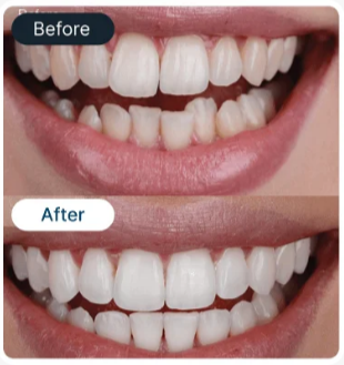 Porcelain veneers result 3 - SmileBetter Kochi