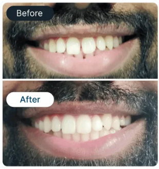 Hollywood smile result 6 - SmileBetter Kochi