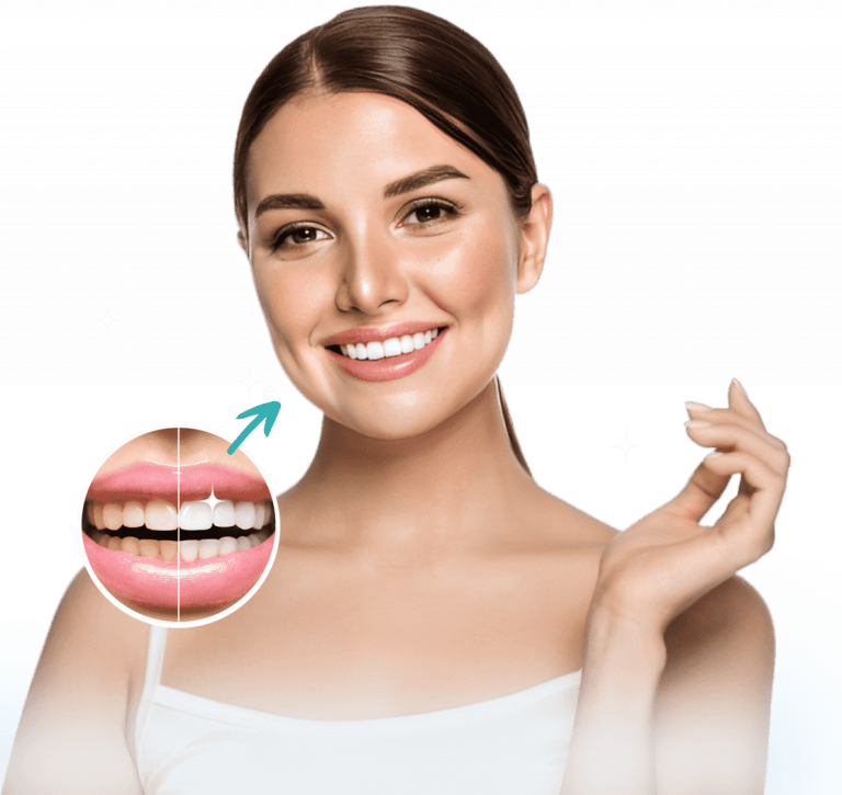 Teeth Whitening Results - Polish & Go Dental Kerala