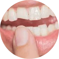 Cracked or chipped teeth