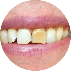 Discoloured teeth