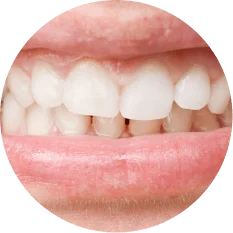 Misaligned teeth