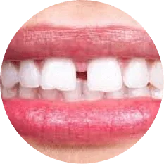 Teeth gaps